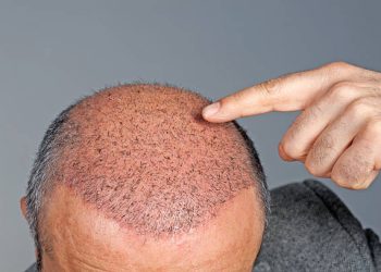 The Hair Restoration Journey: From Bald to Bold