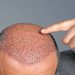 The Hair Restoration Journey: From Bald to Bold