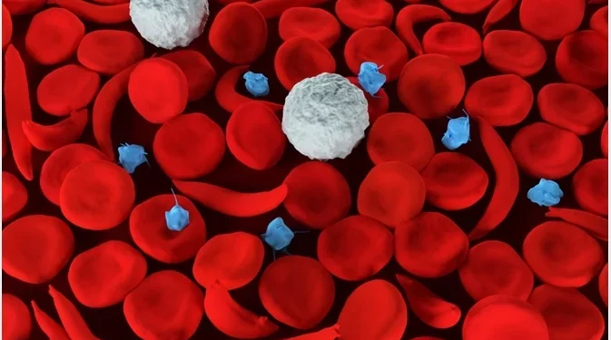 Managing Sickle-cell Anemia: New Treatment Insights