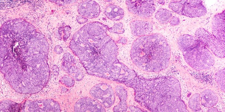 Carcinogenic Cells and IGF-1 DES Research
