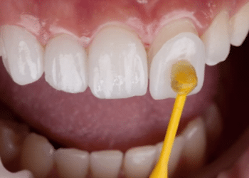 The Subtle Art of Smile Transformation: How Dental Veneers Elevate Self-Esteem