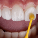 The Subtle Art of Smile Transformation: How Dental Veneers Elevate Self-Esteem