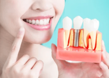 Dental Implants: Revolutionizing Smiles and Oral Health